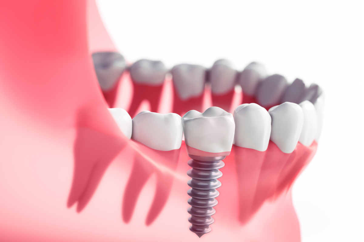 implant-tedavisi-sureci-ve-sonuclari-anlama (4)